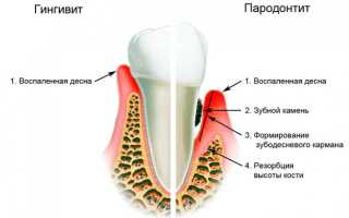 Отек десен: причины, методы лечения, препараты