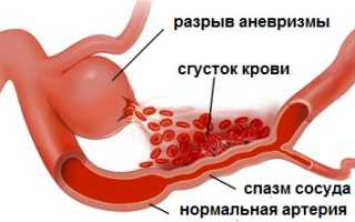 Спазм артерий головного мозга (церебральный вазоспазм)