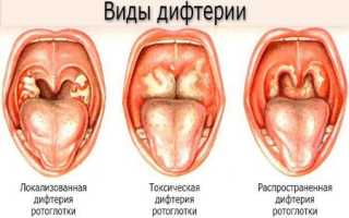 Как вылечить белые точки на миндалинах не выходя из дома