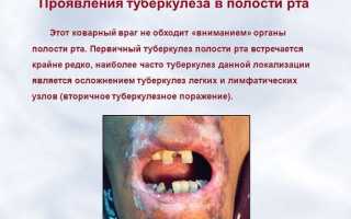Туберкулез полости рта, миндалин и языка