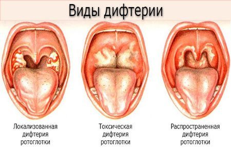 Белые пятна в горле у взрослого фото 10