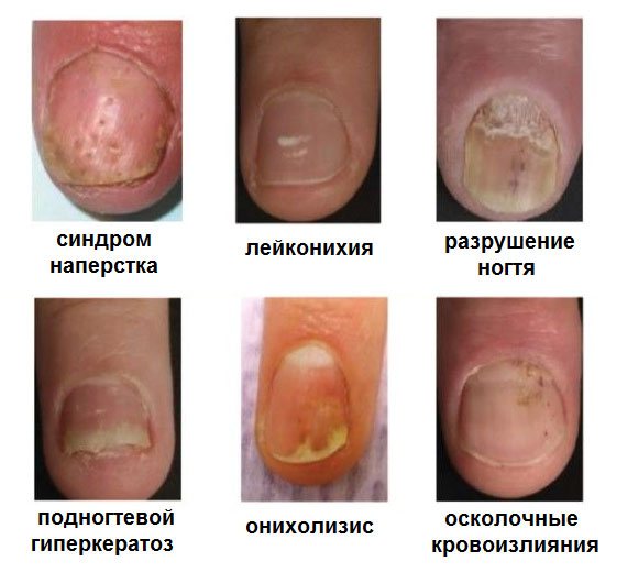 Псориаз ногтей: как привести ногти в порядок? фото