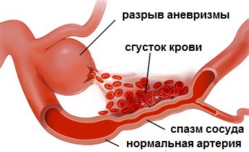 Спазм сосудов головного мозга